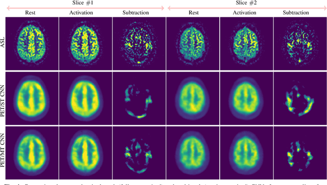 Figure 4 for ASL to PET Translation by a Semi-supervised Residual-based Attention-guided Convolutional Neural Network