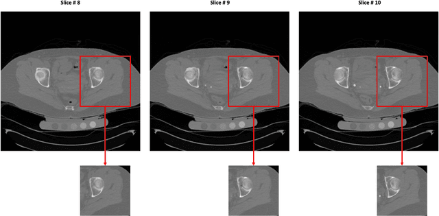 Figure 1 for A Deep Learning-Based Method for Automatic Segmentation of Proximal Femur from Quantitative Computed Tomography Images