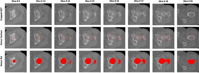 Figure 2 for A Deep Learning-Based Method for Automatic Segmentation of Proximal Femur from Quantitative Computed Tomography Images