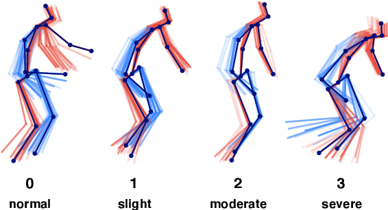 Figure 1 for Vision-based Estimation of MDS-UPDRS Gait Scores for Assessing Parkinson's Disease Motor Severity