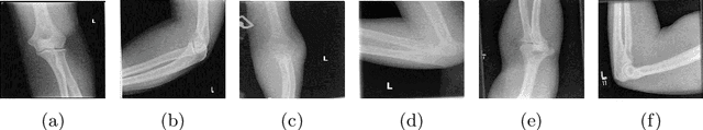 Figure 1 for Knowledge-Guided Multiview Deep Curriculum Learning for Elbow Fracture Classification