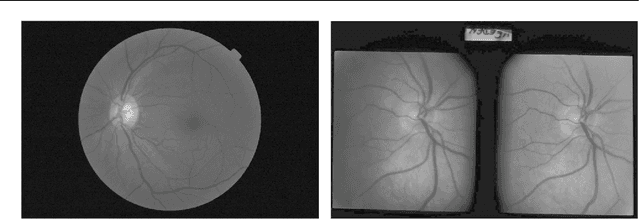 Figure 1 for Evaluation of an AI system for the automated detection of glaucoma from stereoscopic optic disc photographs: the European Optic Disc Assessment Study