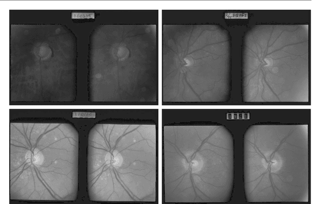 Figure 3 for Evaluation of an AI system for the automated detection of glaucoma from stereoscopic optic disc photographs: the European Optic Disc Assessment Study