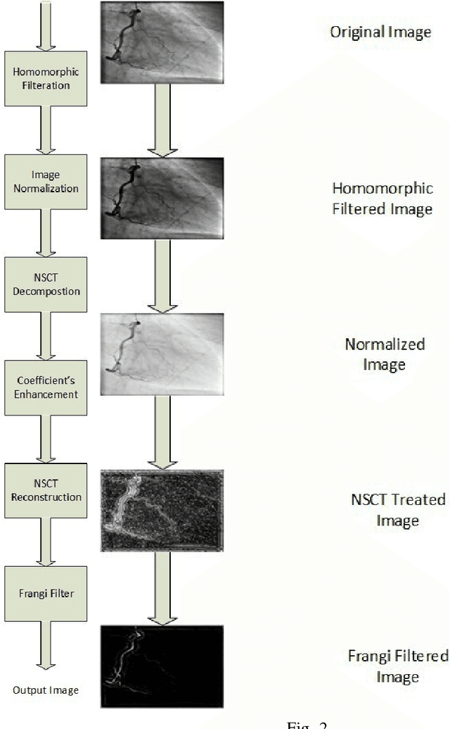 Figure 1 for Removal of Parameter Adjustment of Frangi Filters in Case of Coronary Angiograms