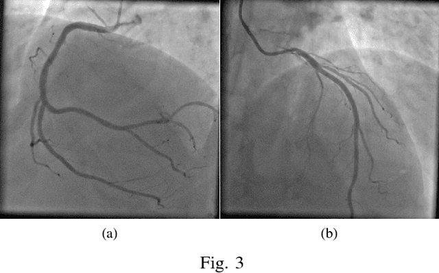Figure 2 for Removal of Parameter Adjustment of Frangi Filters in Case of Coronary Angiograms