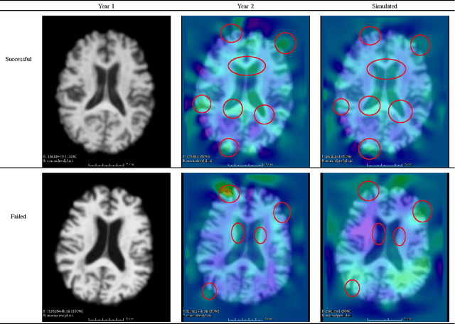 Figure 4 for Morphometry-Based Longitudinal Neurodegeneration Simulation with MR Imaging