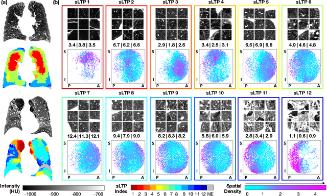 Figure 3 for Novel Subtypes of Pulmonary Emphysema Based on Spatially-Informed Lung Texture Learning
