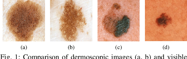 Figure 1 for Accessible Melanoma Detection using Smartphones and Mobile Image Analysis