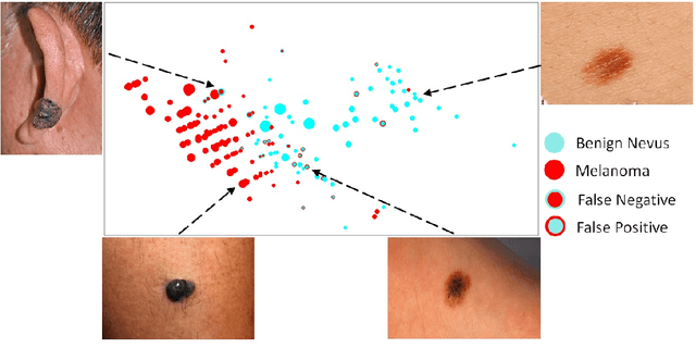 Figure 2 for Accessible Melanoma Detection using Smartphones and Mobile Image Analysis