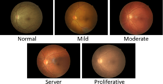 Figure 3 for Sea-Net: Squeeze-And-Excitation Attention Net For Diabetic Retinopathy Grading