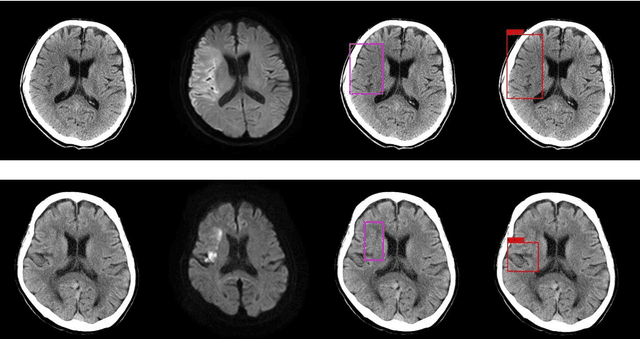 Figure 3 for Automatic detection of acute ischemic stroke using non-contrast computed tomography and two-stage deep learning model