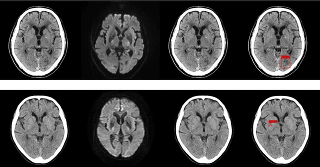 Figure 4 for Automatic detection of acute ischemic stroke using non-contrast computed tomography and two-stage deep learning model