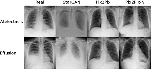 Figure 3 for Adversarial Pulmonary Pathology Translation for Pairwise Chest X-ray Data Augmentation