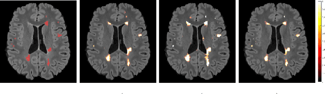 Figure 2 for Shallow vs deep learning architectures for white matter lesion segmentation in the early stages of multiple sclerosis