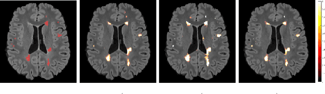 Figure 2 for Shallow vs deep learning architectures for white matter lesion segmentation in the early stages of multiple sclerosis