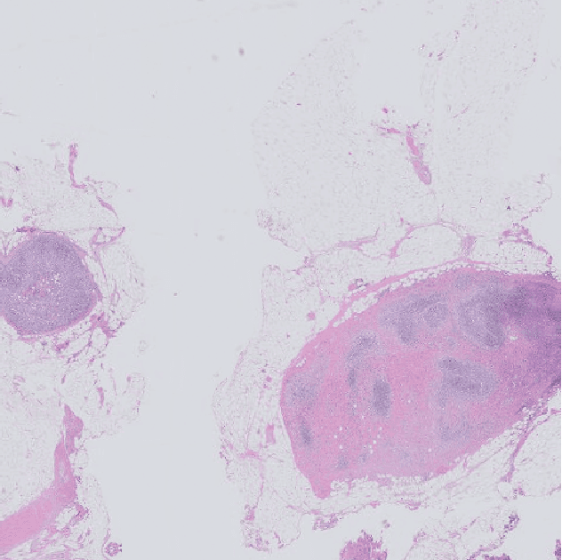 Figure 3 for Automatic breast cancer grading in lymph nodes using a deep neural network