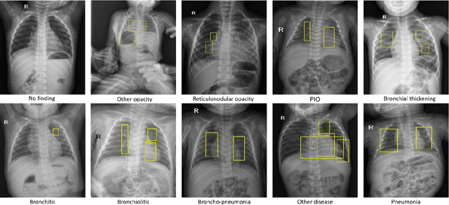 Figure 3 for VinDr-PCXR: An open, large-scale chest radiograph dataset for interpretation of common thoracic diseases in children