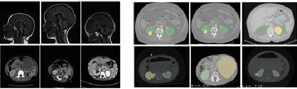 Figure 1 for Automatic size and pose homogenization with spatial transformer network to improve and accelerate pediatric segmentation