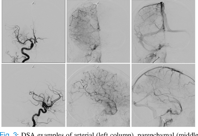 Figure 3 for autoTICI: Automatic Brain Tissue Reperfusion Scoring on 2D DSA Images of Acute Ischemic Stroke Patients