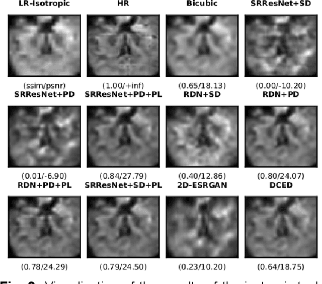 Figure 4 for Perceptual cGAN for MRI Super-resolution