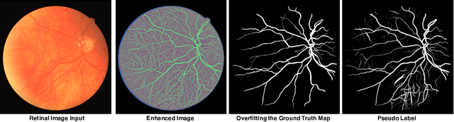 Figure 3 for Study Group Learning: Improving Retinal Vessel Segmentation Trained with Noisy Labels