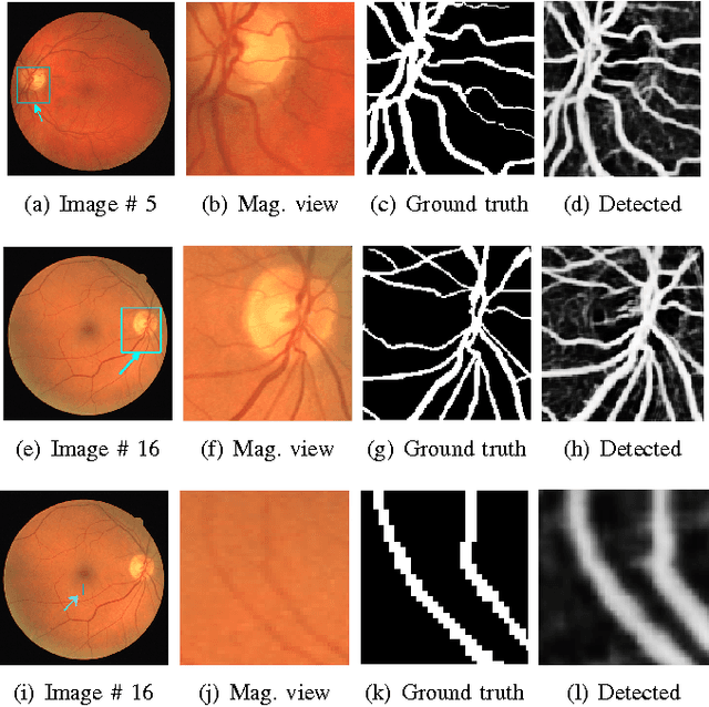 Figure 3 for Ensemble of Deep Convolutional Neural Networks for Learning to Detect Retinal Vessels in Fundus Images