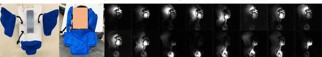 Figure 1 for Rapid dynamic speech imaging at 3 Tesla using combination of a custom vocal tract coil, variable density spirals and manifold regularization