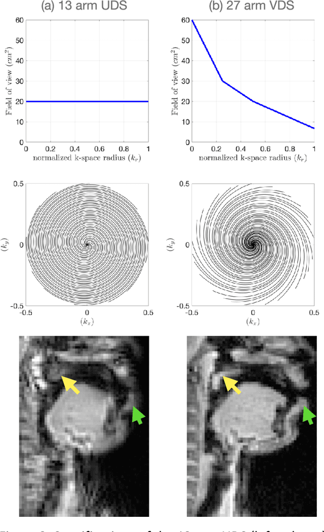 Figure 2 for Rapid dynamic speech imaging at 3 Tesla using combination of a custom vocal tract coil, variable density spirals and manifold regularization