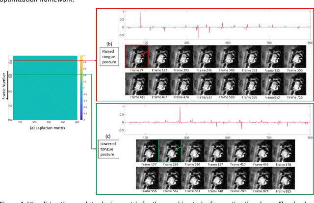 Figure 4 for Rapid dynamic speech imaging at 3 Tesla using combination of a custom vocal tract coil, variable density spirals and manifold regularization