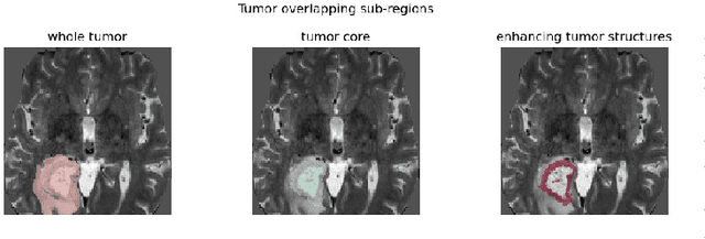 Figure 4 for Non Parametric Data Augmentations Improve Deep-Learning based Brain Tumor Segmentation