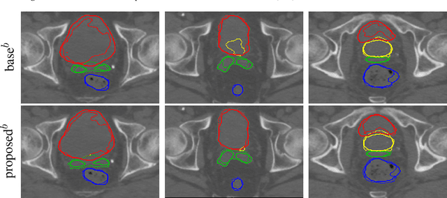 Figure 4 for Patient-Specific Finetuning of Deep Learning Models for Adaptive Radiotherapy in Prostate CT