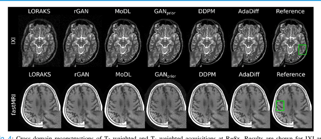 Figure 4 for Adaptive Diffusion Priors for Accelerated MRI Reconstruction