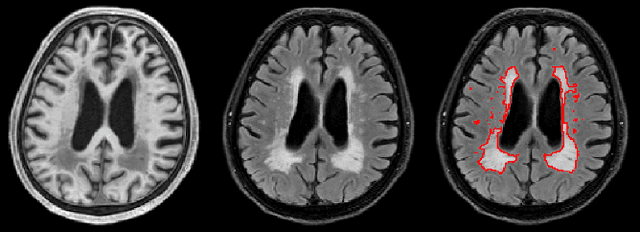 Figure 1 for White matter hyperintensity segmentation from T1 and FLAIR images using fully convolutional neural networks enhanced with residual connections