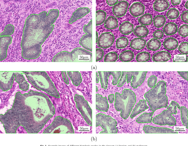 Figure 1 for Gland Segmentation in Colon Histology Images: The GlaS Challenge Contest