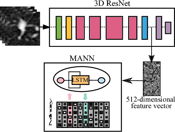 Figure 1 for Lung Cancer Screening Using Adaptive Memory-Augmented Recurrent Networks