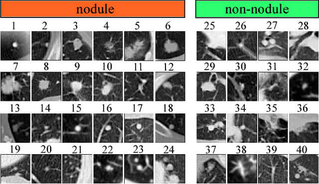 Figure 2 for Lung Cancer Screening Using Adaptive Memory-Augmented Recurrent Networks