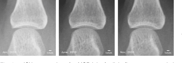 Figure 1 for A Sub-pixel Accurate Quantification of Joint Space Narrowing Progression in Rheumatoid Arthritis