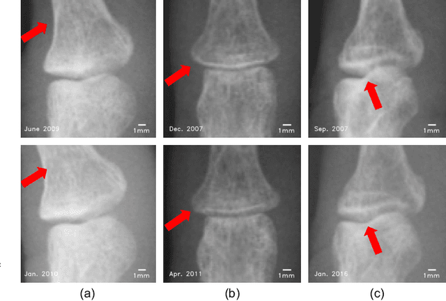 Figure 4 for A Sub-pixel Accurate Quantification of Joint Space Narrowing Progression in Rheumatoid Arthritis