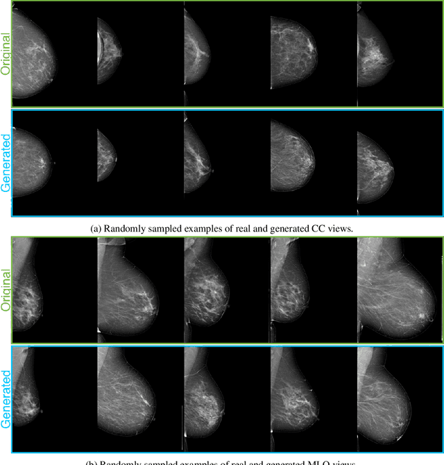 Figure 4 for High-Resolution Mammogram Synthesis using Progressive Generative Adversarial Networks