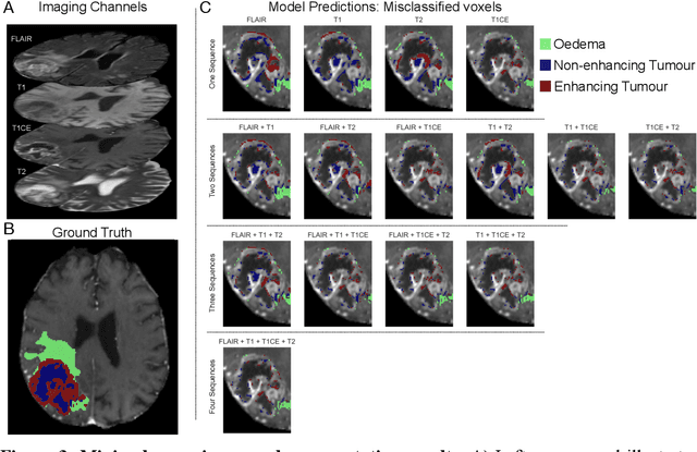 Figure 3 for Translating automated brain tumour phenotyping to clinical neuroimaging