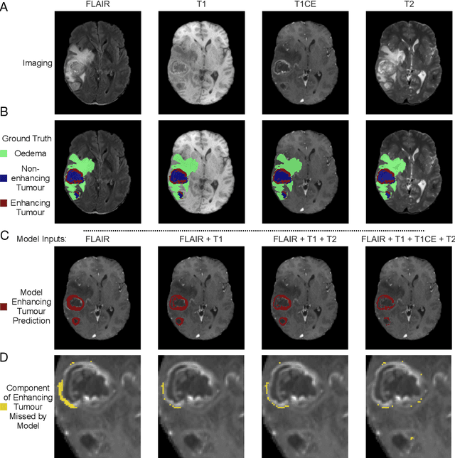 Figure 4 for Translating automated brain tumour phenotyping to clinical neuroimaging