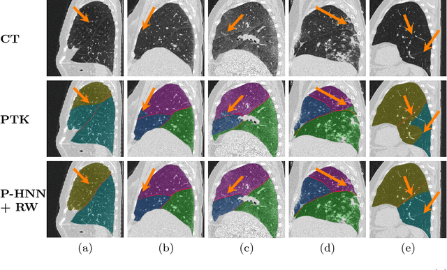 Figure 3 for Pathological Pulmonary Lobe Segmentation from CT Images using Progressive Holistically Nested Neural Networks and Random Walker