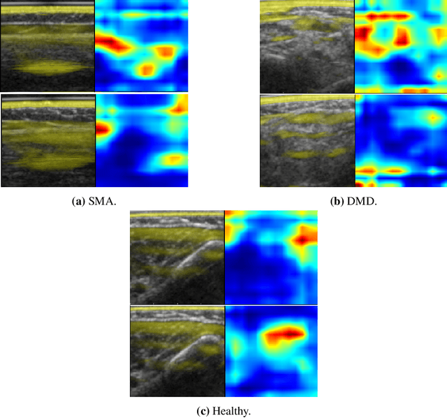 Figure 1 for Automatic Classification of Neuromuscular Diseases in Children Using Photoacoustic Imaging
