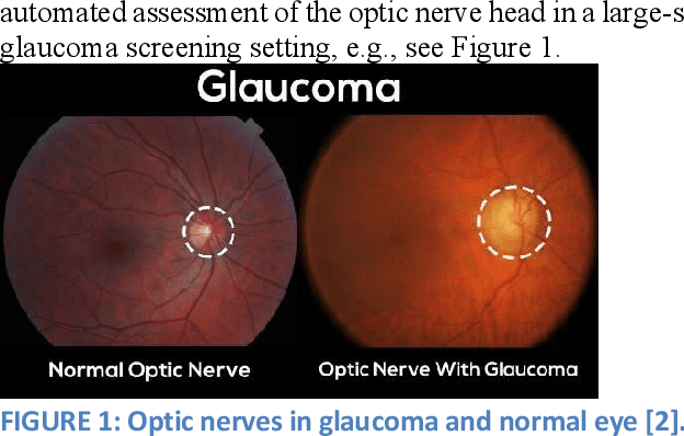 Figure 1 for Real-Time Glaucoma Detection from Digital Fundus Images using Self-ONNs