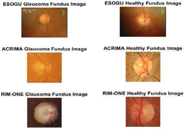 Figure 3 for Real-Time Glaucoma Detection from Digital Fundus Images using Self-ONNs