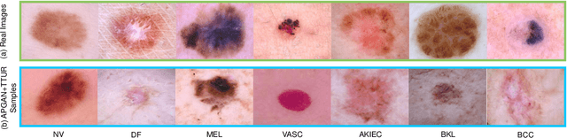 Figure 1 for Data Augmentation for Skin Lesion using Self-Attention based Progressive Generative Adversarial Network