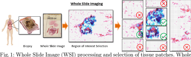 Figure 1 for Leveraging Uncertainty in Deep Learning for Pancreatic Adenocarcinoma Grading
