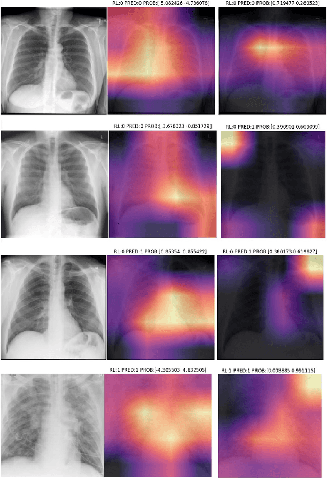 Figure 1 for Correcting Data Imbalance for Semi-Supervised Covid-19 Detection Using X-ray Chest Images