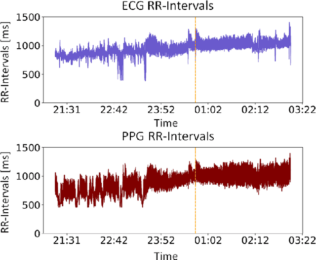 Figure 1 for Automatic Seizure Detection Using the Pulse Transit Time