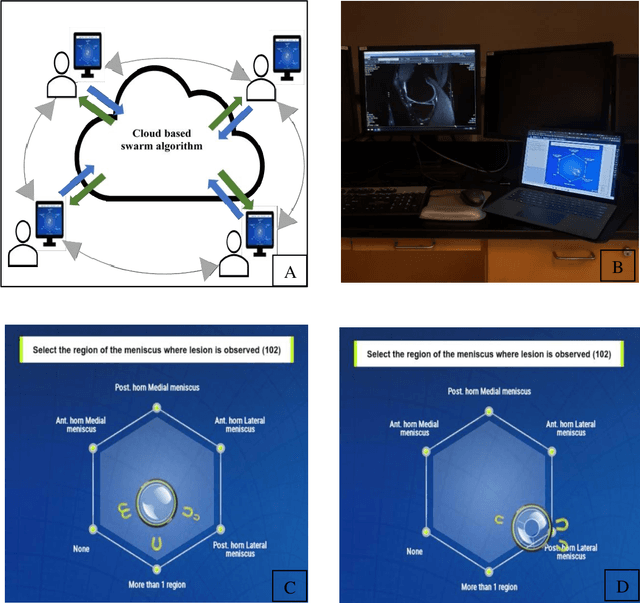 Figure 4 for Leveraging wisdom of the crowds to improve consensus among radiologists by real time, blinded collaborations on a digital swarm platform